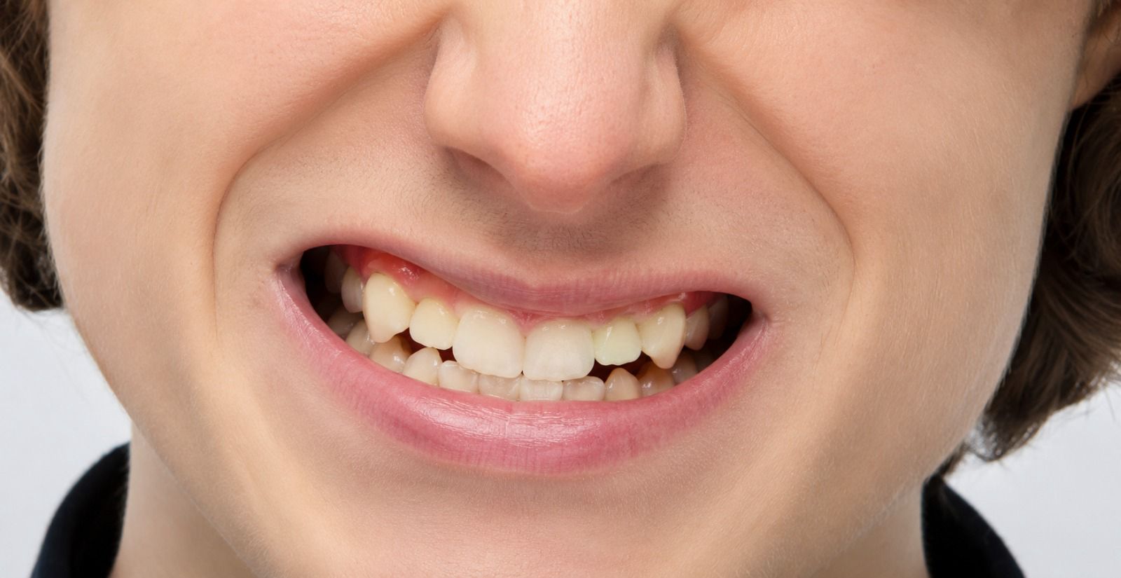 Close-up of a child’s mouth showing signs of teeth grinding, including worn teeth and irritated gums.