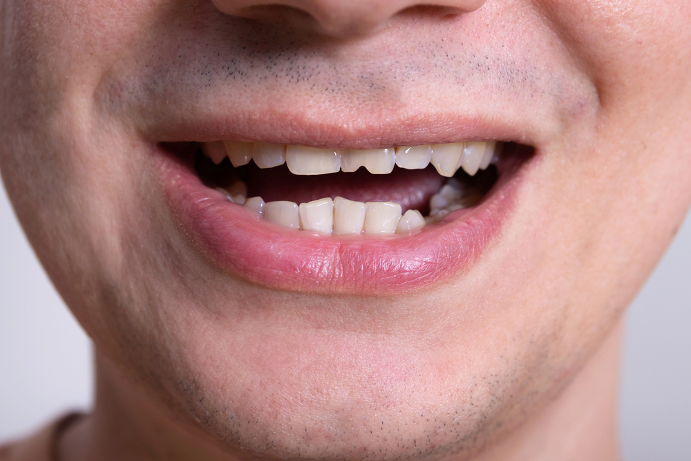 Close-up of a man’s smile showing chipped edges on the upper front teeth.