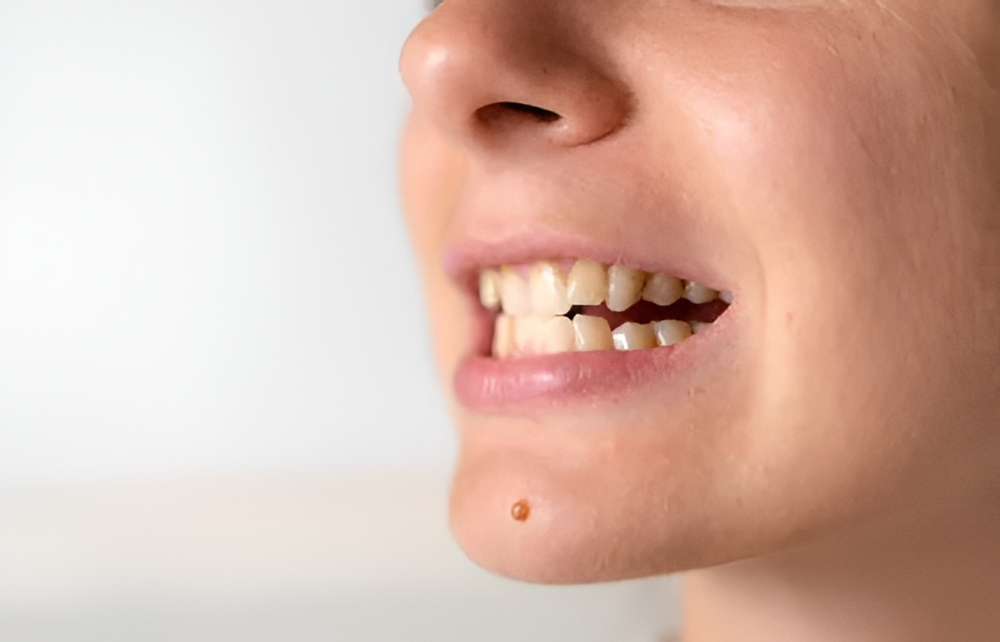 Close-up of a person's mouth with slightly crooked teeth from tooth grinding.