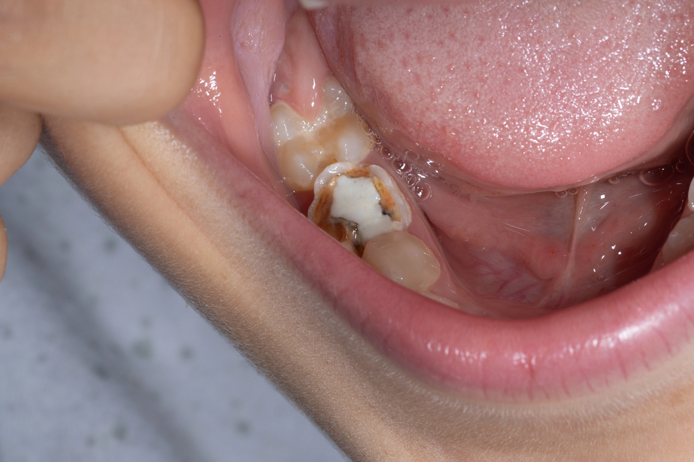 Fissure sealant protecting the grooves of a child’s back tooth