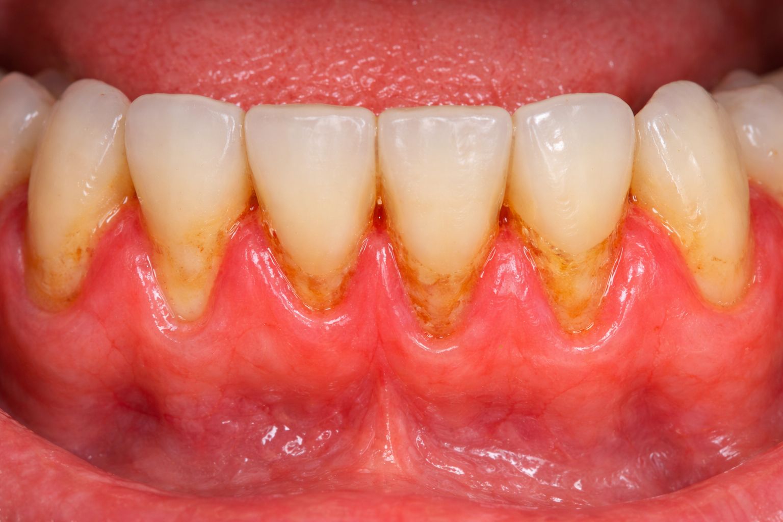 Close-up of gum recession around teeth showing signs of periodontal disease