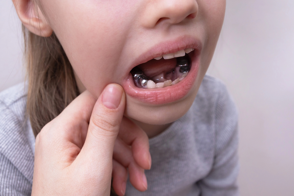Stainless steel Hall crown used on a decayed baby molar