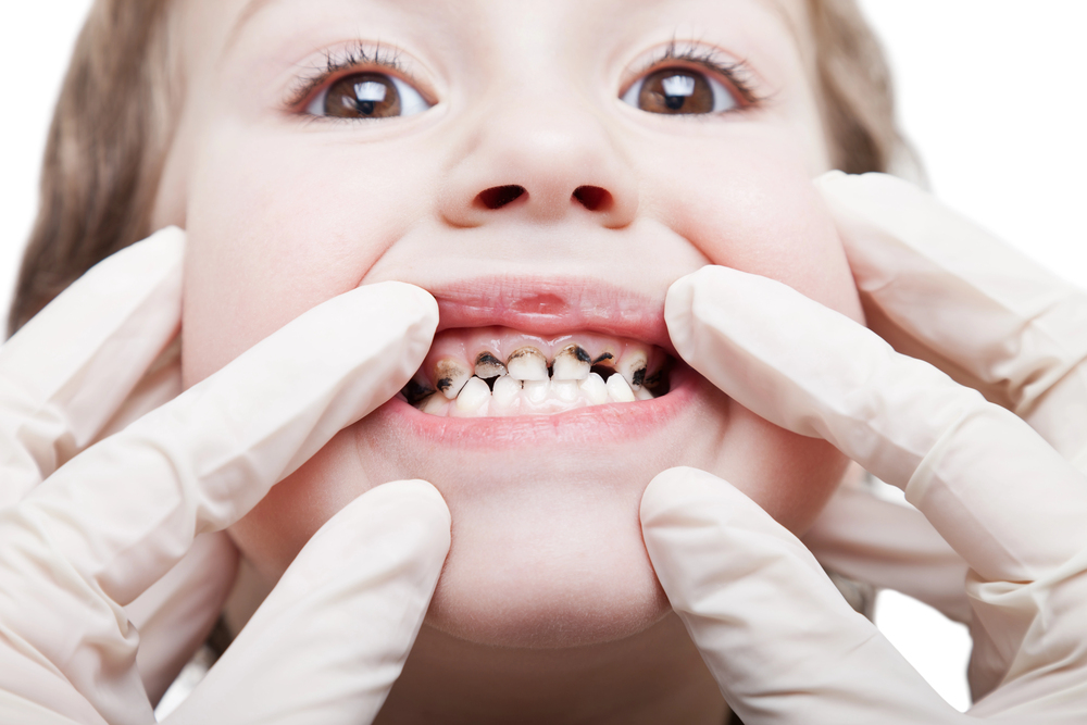 Silver Diamine Fluoride used to manage tooth decay in a child