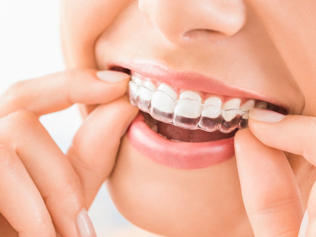 Close-up of a person using Invisalign mouth guard to stop grinding teeth. 